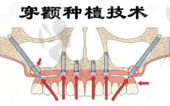 穿颧穿翼种植牙