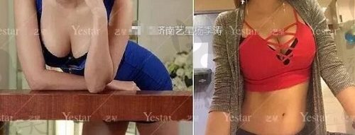 济南艺星杨继涛医生假体隆胸术后