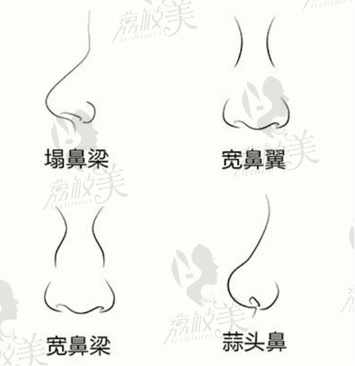 鼻型分类