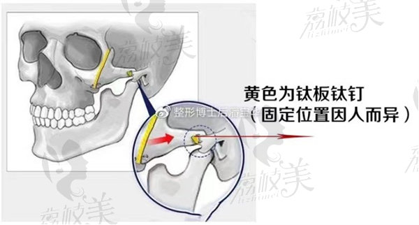 钛板钛钉固定法+中面部提拉