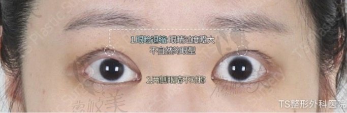 韩国TS眼修复手术方案分析