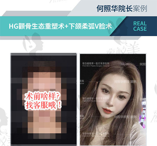 何照华医生下颌角真人术后图