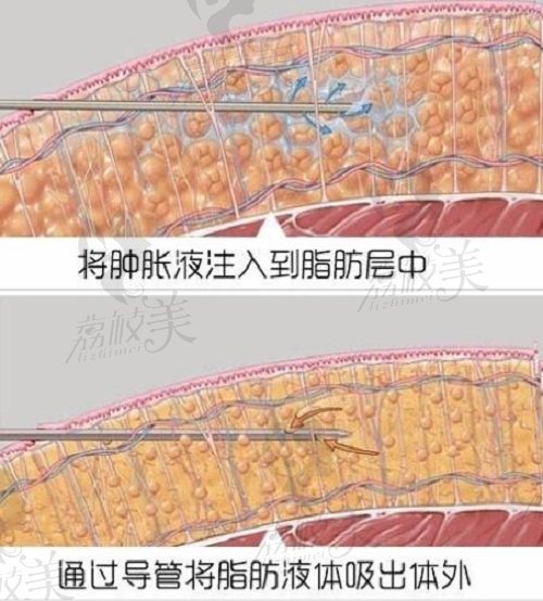 北京雅靚醫(yī)療吸脂方式