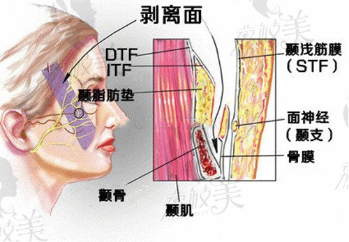 北京八大處楊欣做的微創(chuàng)懸吊提升原理