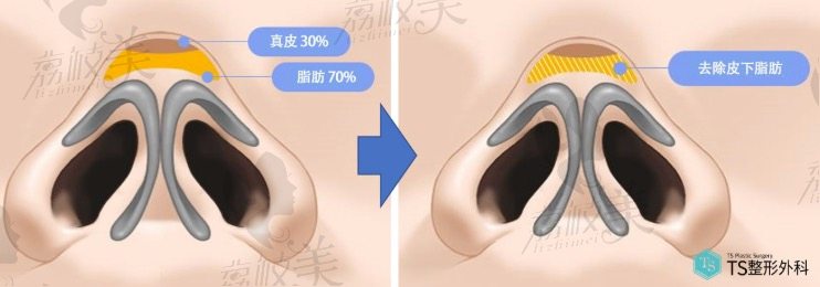 去除肥厚的皮下組織