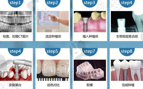 杭州植得口腔种植牙过程