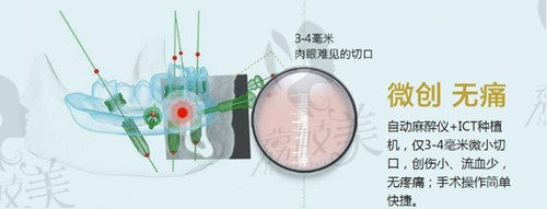 杭州植得口腔半口/全口种植牙特点