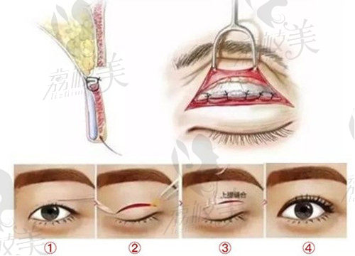 西安画美割双眼皮PARK法操作过程