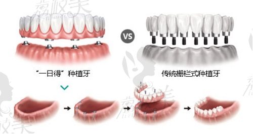 贵阳牙博士口腔医院种植牙