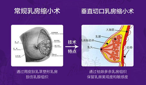 乳房缩小术技术