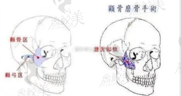 重庆潘宝华做颧骨固定