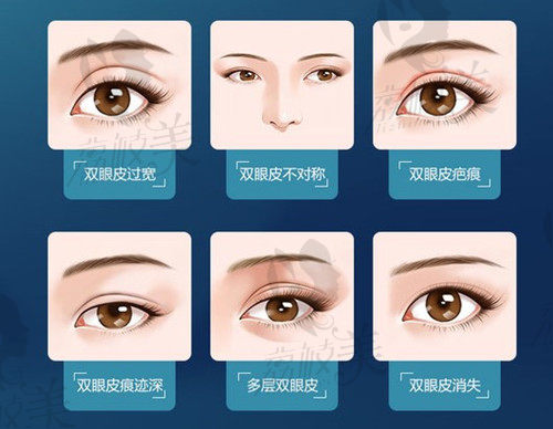 不得不说成都江涛医生做双眼皮修复好，这几组修复后图片很赞