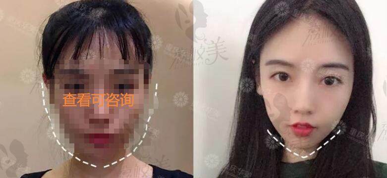 重庆华美整形磨骨术后