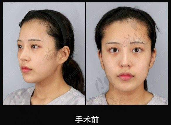 韩国TS下颌角手术前照片