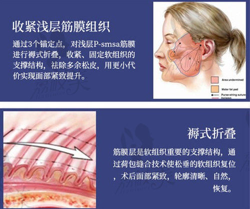 南京苏王整形拉皮手术优势