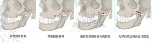 南京友谊颧骨内推技术