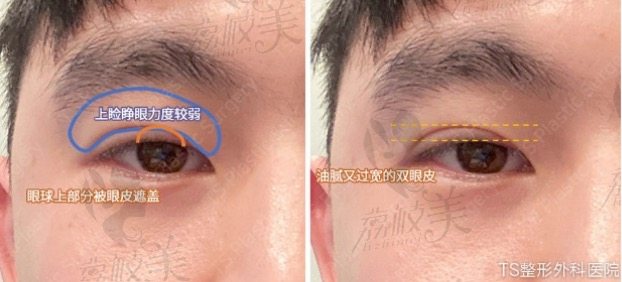 双眼皮改单眼皮手术分析