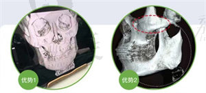 杭州时光3D颧骨颧弓整形优势