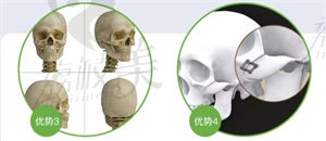 杭州时光3D颧骨颧弓整形优势