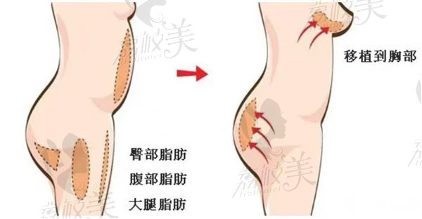 杭州同荣丽格自体脂肪丰胸