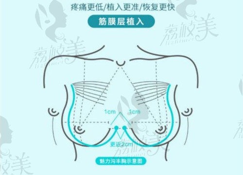 广州中家医家庭医生整形假体隆胸特色
