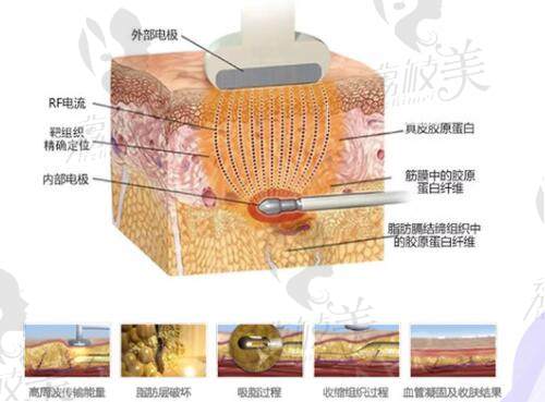 黄金微雕吸脂原理