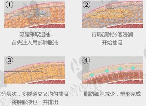 上海华美何斌医生分层吸脂手术方式