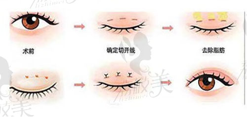 南医大友谊整形双眼皮