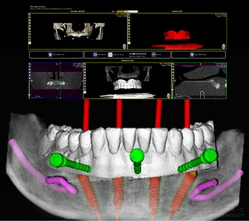 廣州德倫口腔數(shù)字化種植牙
