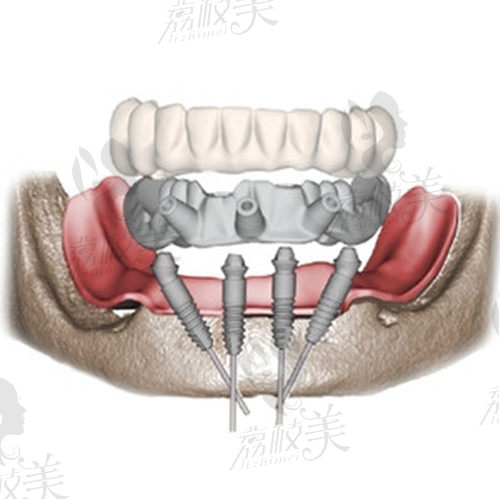 广州德伦口腔all-on-4种植