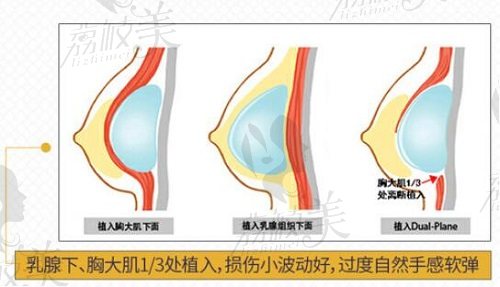 重庆华美双平面隆胸技术