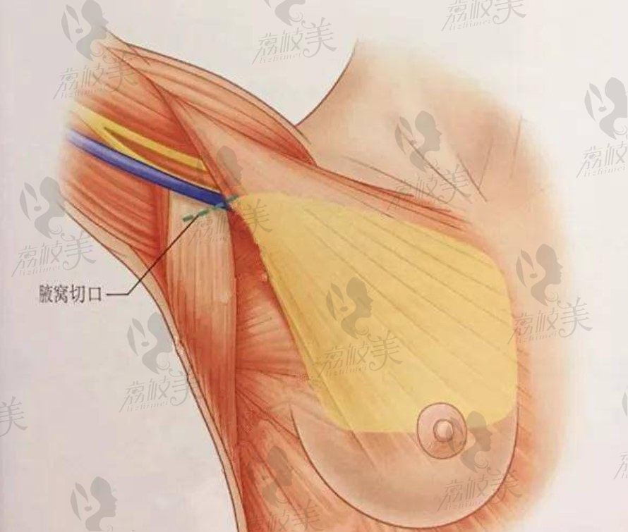 隆胸腋窝切口