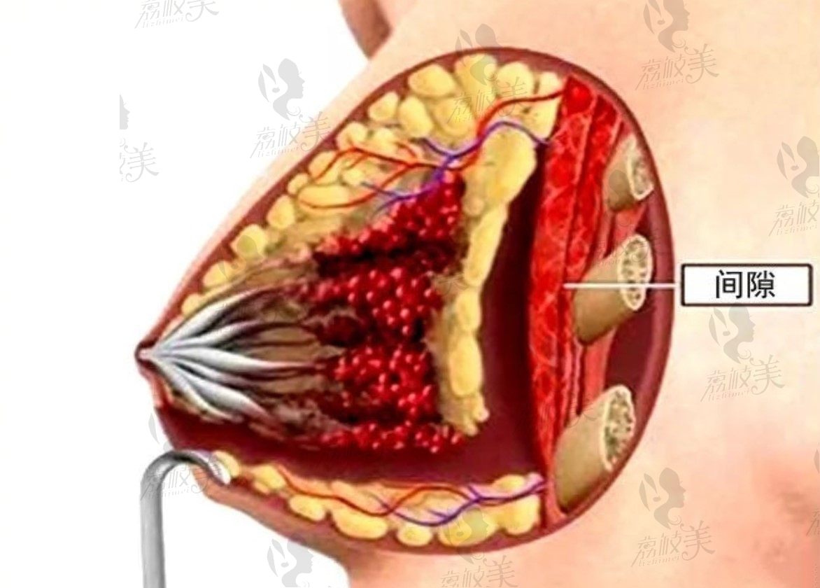隆胸乳晕切口