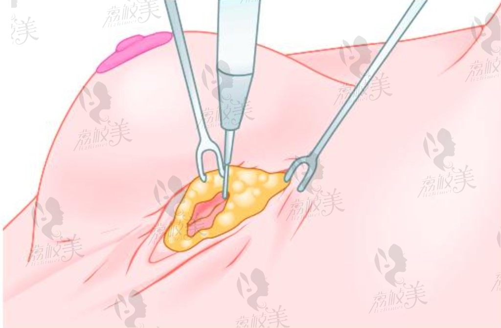隆胸乳房下皱襞切口
