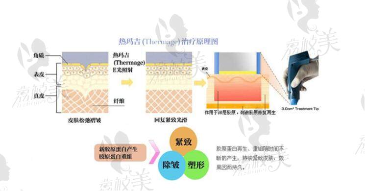 热玛吉治疗原理图