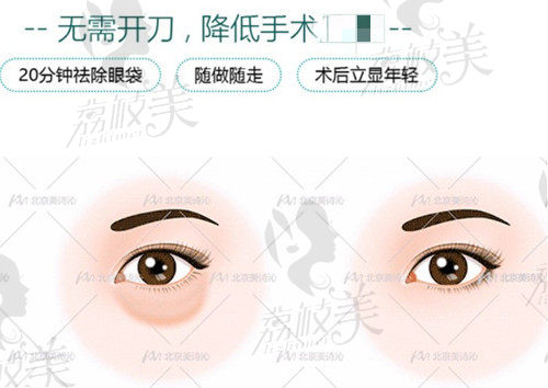 北京美诗沁做去眼袋示意图
