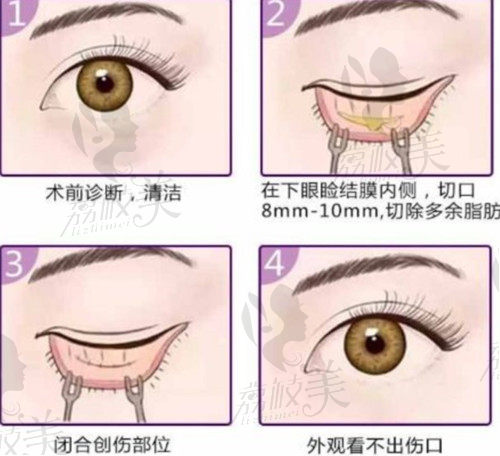 北京丽星翼美去眼袋示意图