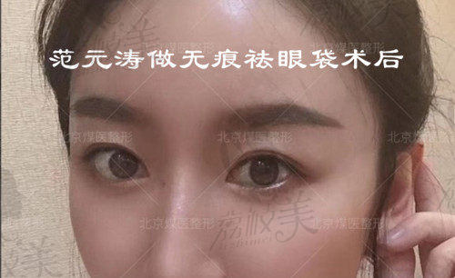 北京煤医范元涛做去眼袋术后