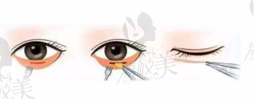 北京嘉禾去眼袋示意图