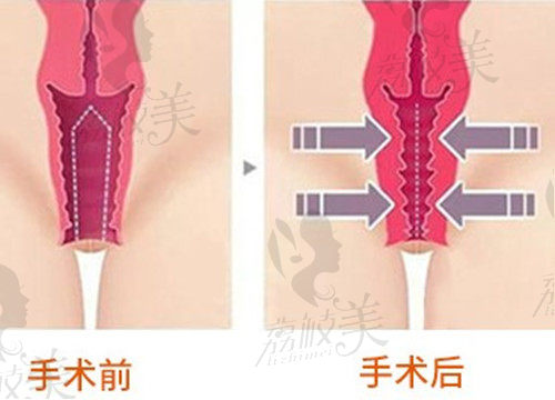 西安国丨际整形缩阴术优势