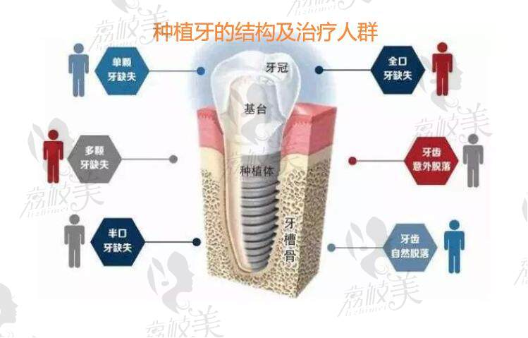 种植牙适应症和种植牙结构