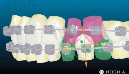 牙齿矫正的原理