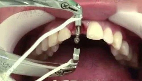 种植牙质量导致种植牙松动
