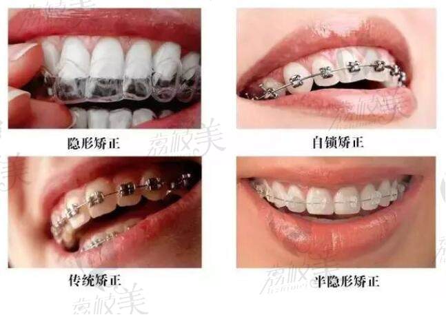 牙齿矫正的方式