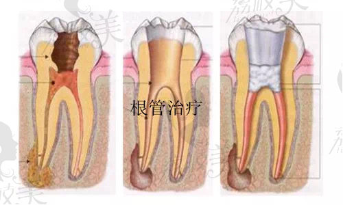 根管治疗的步骤显示