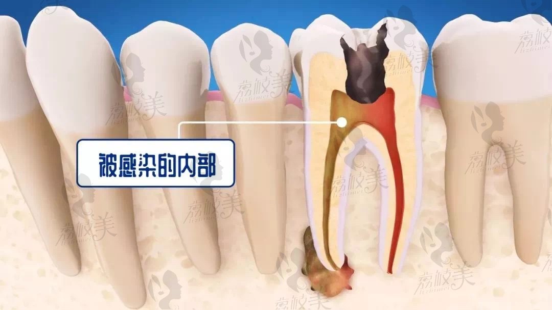 蛀牙被感染的内部图片