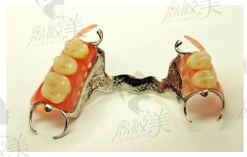 活动义齿的牙齿缺失修复方式