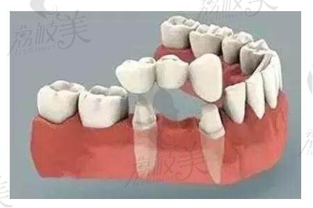 固定义齿的修复方式