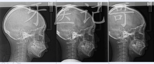 福州维乐口腔徐长记骨性凸嘴矫正病例