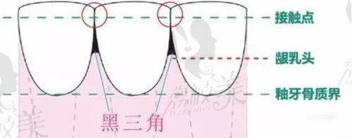 牙龈萎缩造成黑三角